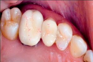 Dental Fillings Matter