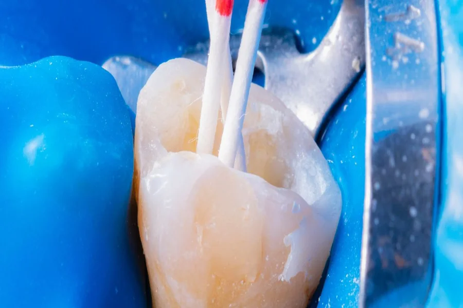 Laser-Assisted Root Canal_ Dentistry’s Painless New Option